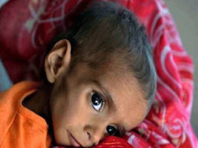 مٹھی میں بھوک سے مزید پانچ بچے دم توڑگئے،رواں سال بیماری اور بھوک سے مرنےوالے بچوں کی تعداد 235 ہوگئی